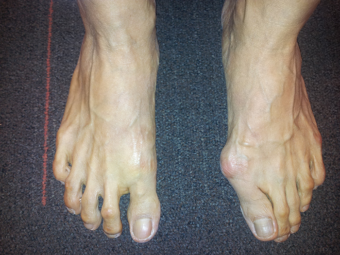 Bunion Foot Deformity