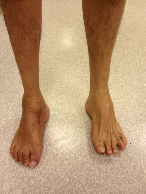 Corrected Right Hindfoot Varus Deformity (Front View)