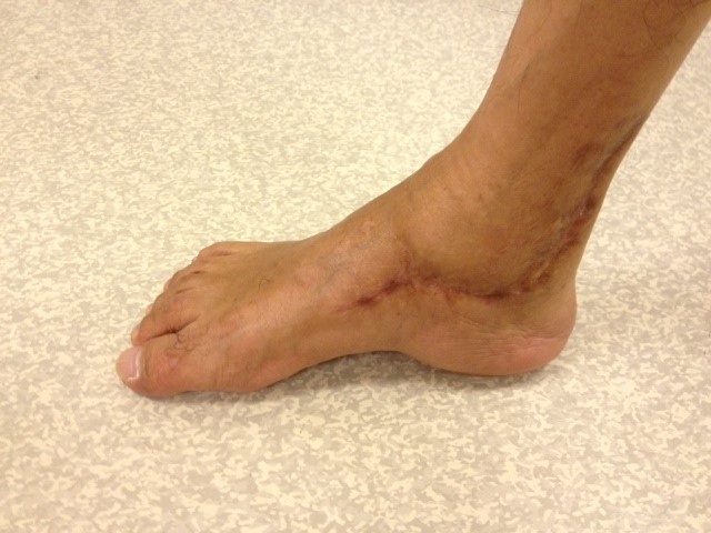 Corrected Right Hindfoot Varus Deformity (Medial View)