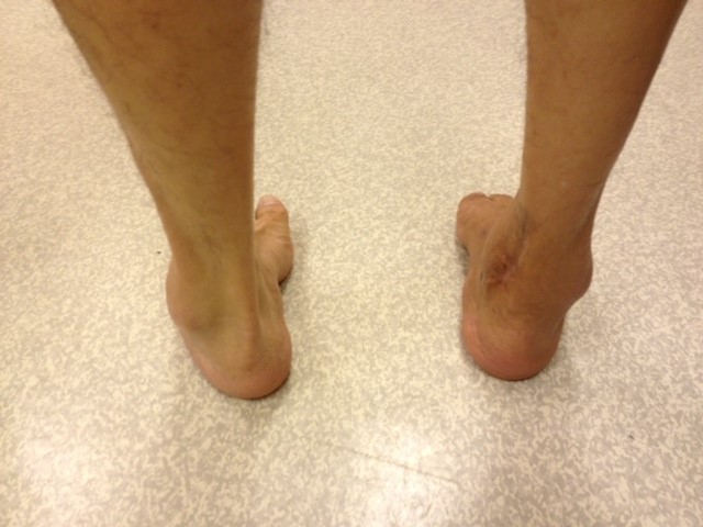 Corrected Right Hindfoot Varus Deformity (Rear View)