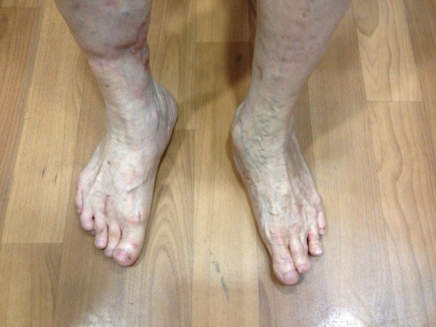 Post Op Corrected Severe Foot Deformity
