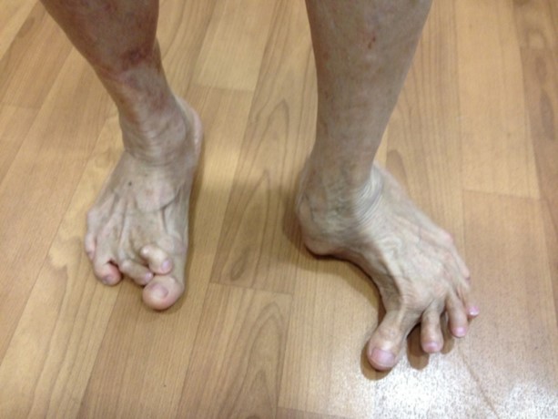 Pre Op Severe Foot Deformity