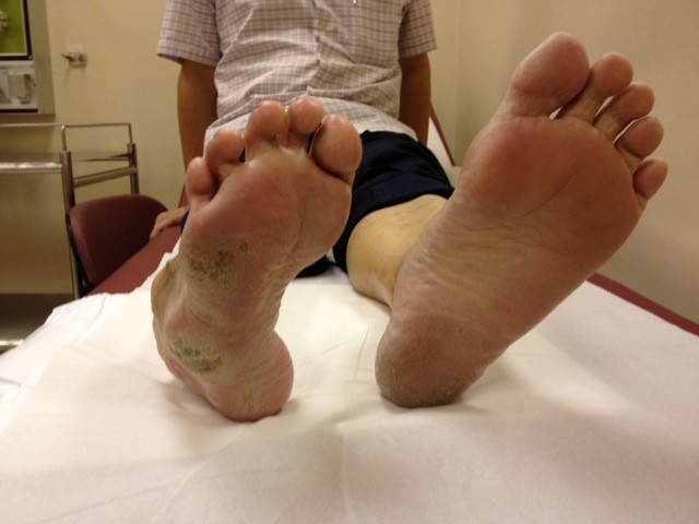 Uncorrected Right Foot Deformity with Callosity on Sole