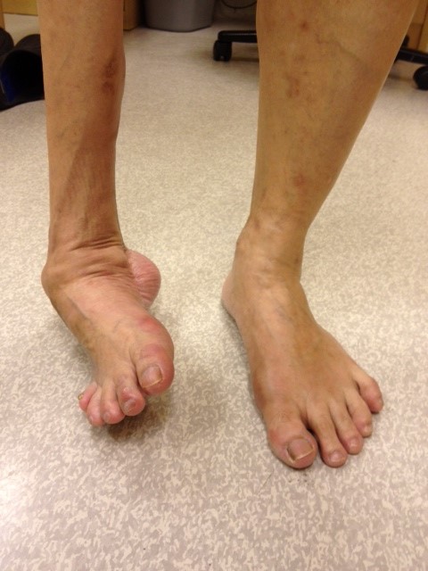 Uncorrected Right Foot Deformity