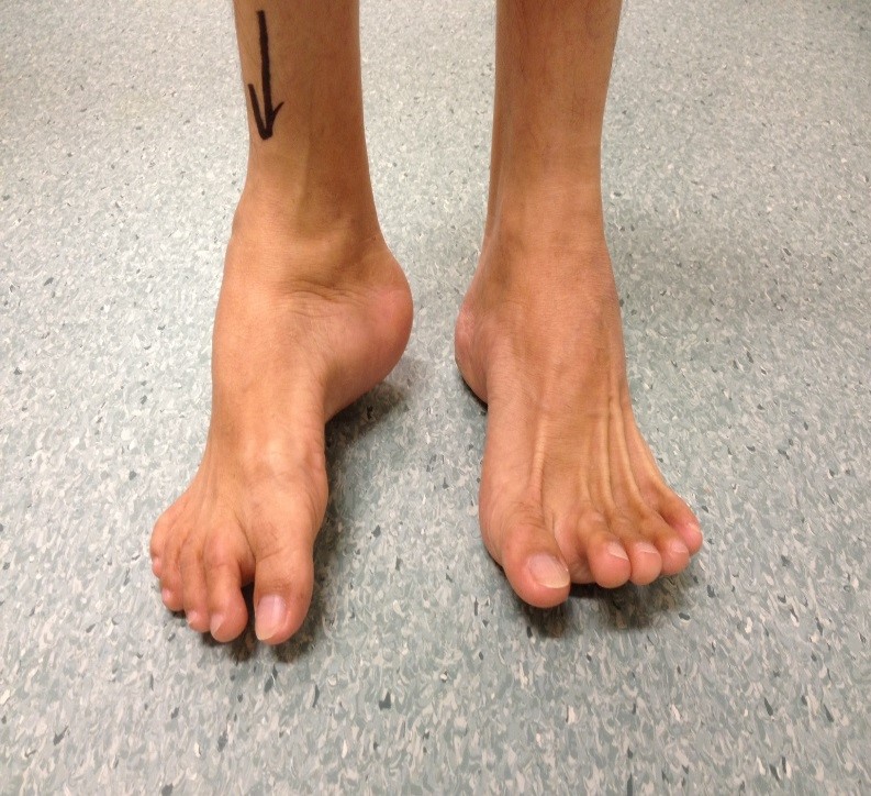 Uncorrected Right Hindfoot Varus Deformity (Front View)