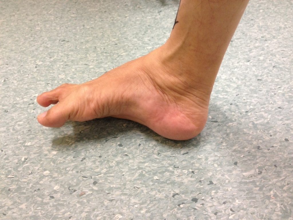 Uncorrected Right Hindfoot Varus Deformity (Medial View)