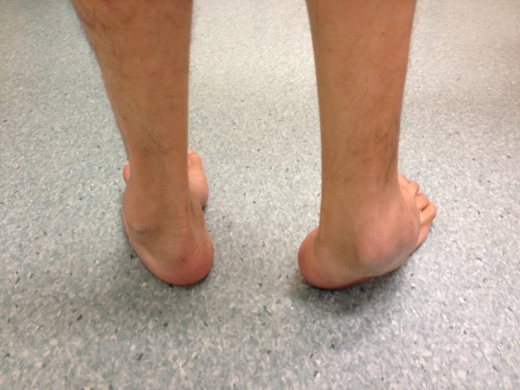 Uncorrected Right Hindfoot Varus Deformity (Rear View)